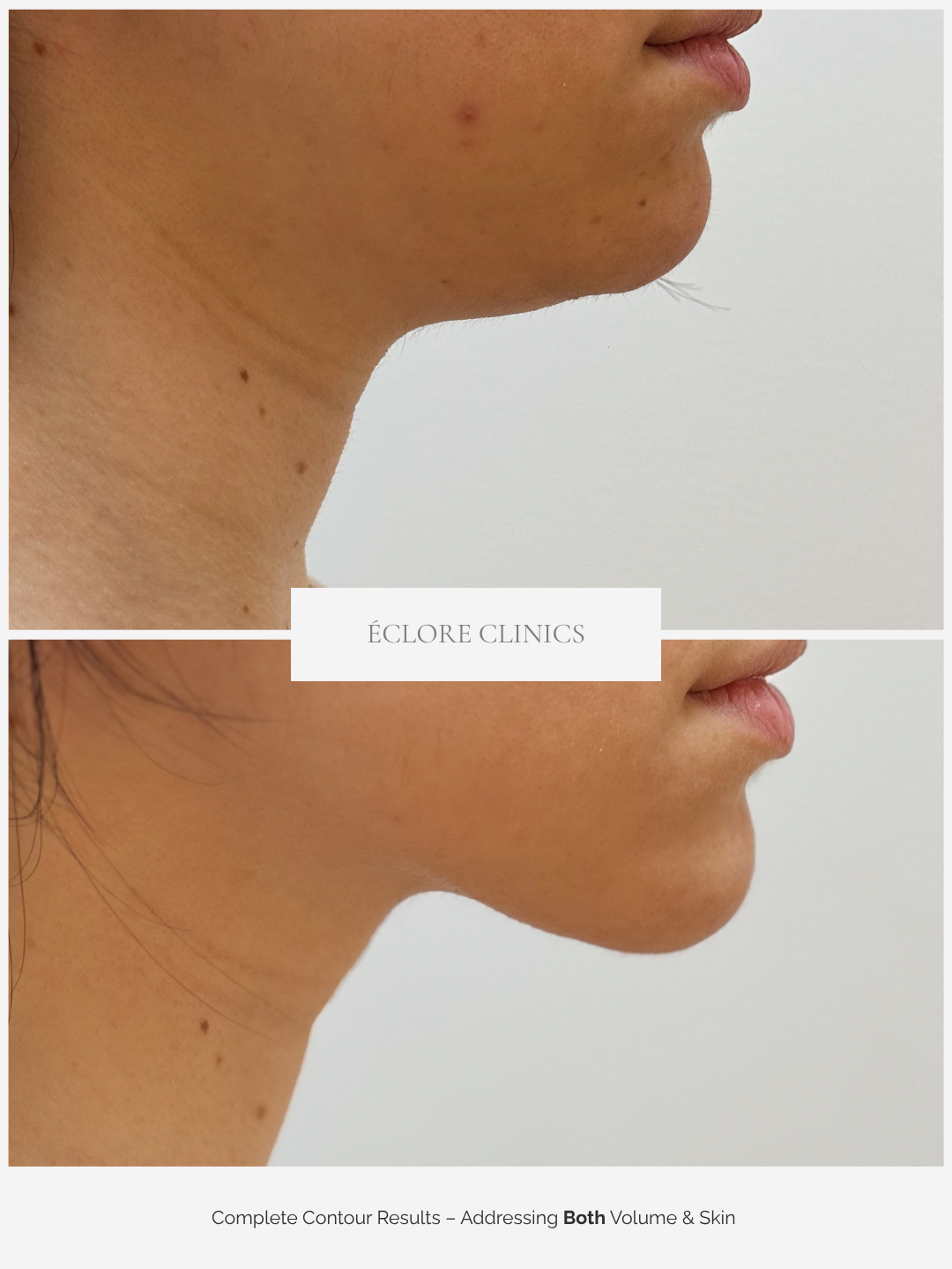 Before and after Chin & Jawline Contour at Éclore Clinics — complete contour results