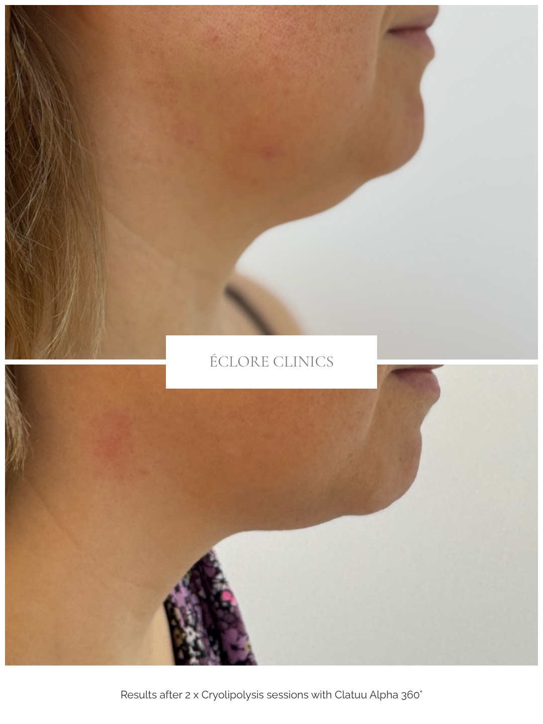 Before and after Cryolipolysis at Éclore Clinics — profile results after 2 sessions
