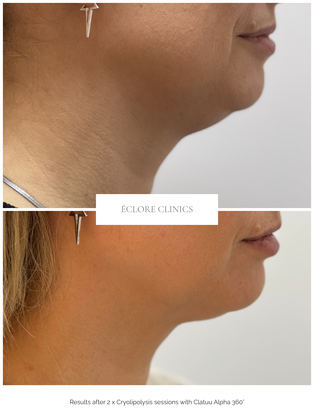 Before and after Cryolipolysis at Éclore Clinics — profile results
