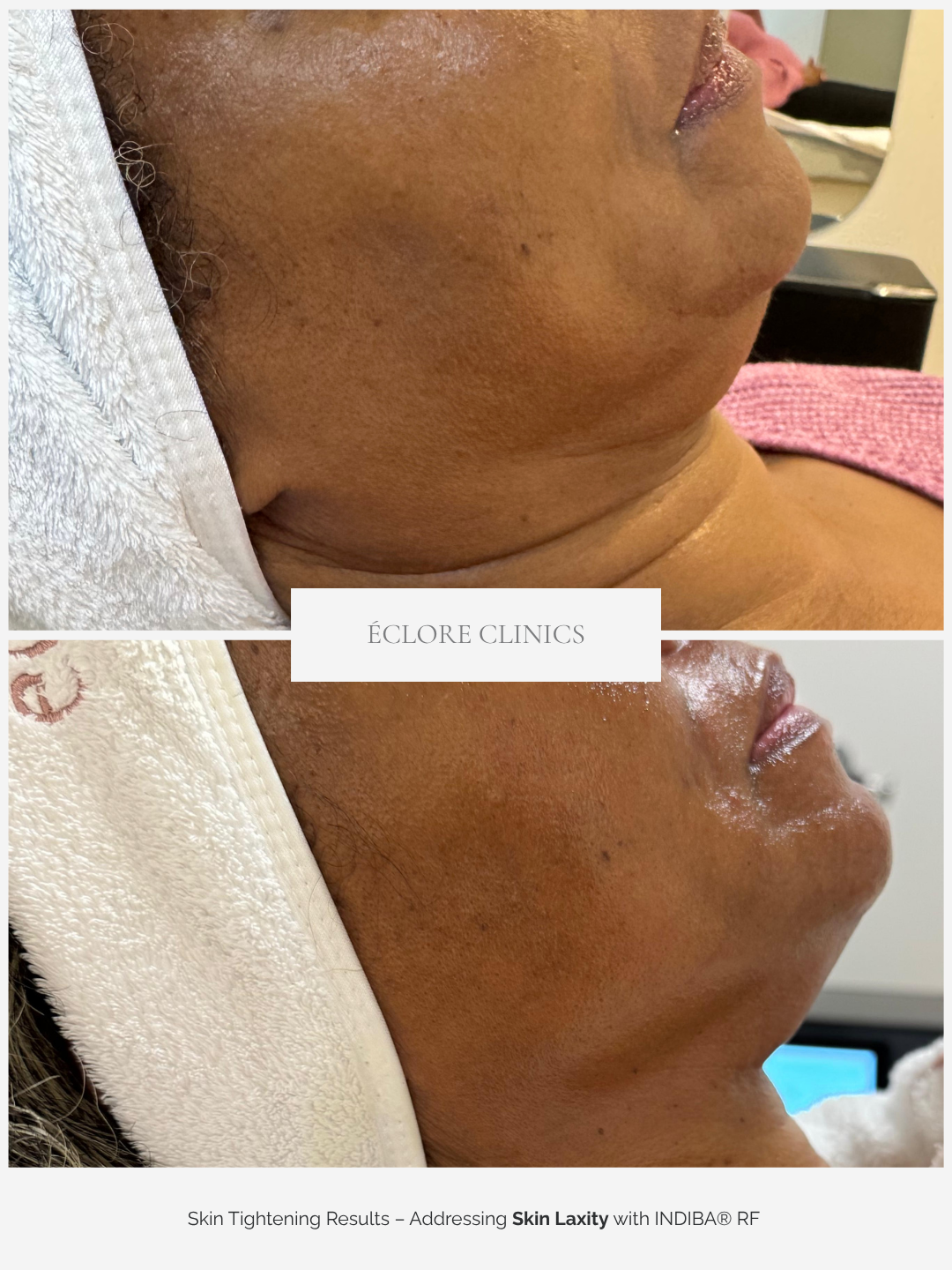 Before and after INDIBA RF skin tightening at Éclore Clinics — skin laxity results