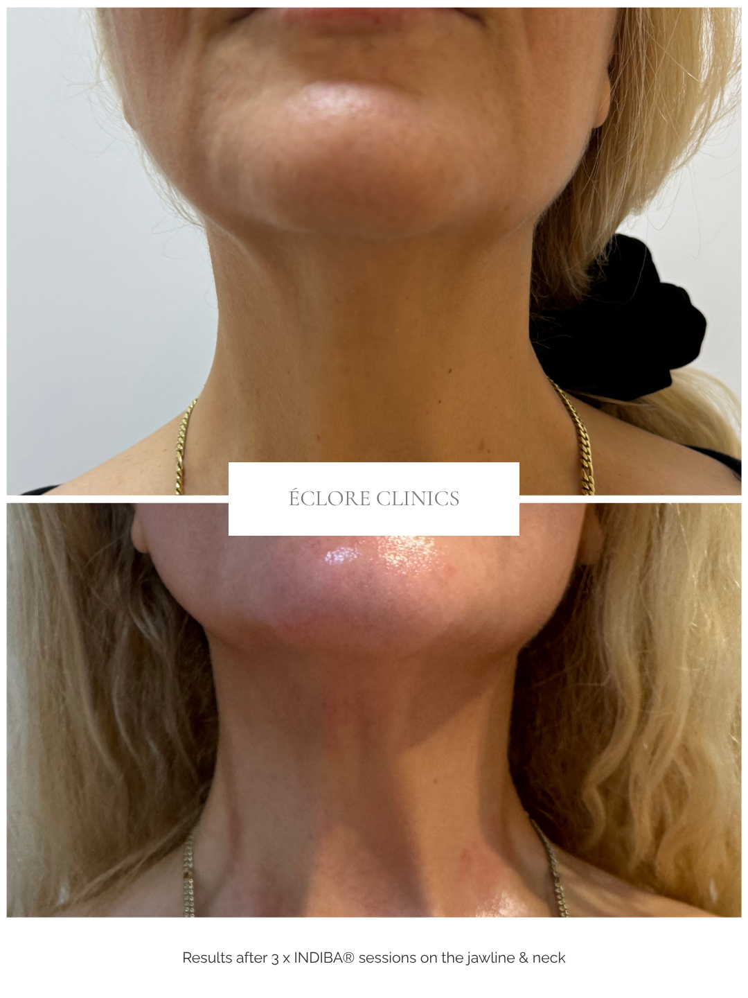 Before and after INDIBA RF jawline treatment at Éclore Clinics — neck results