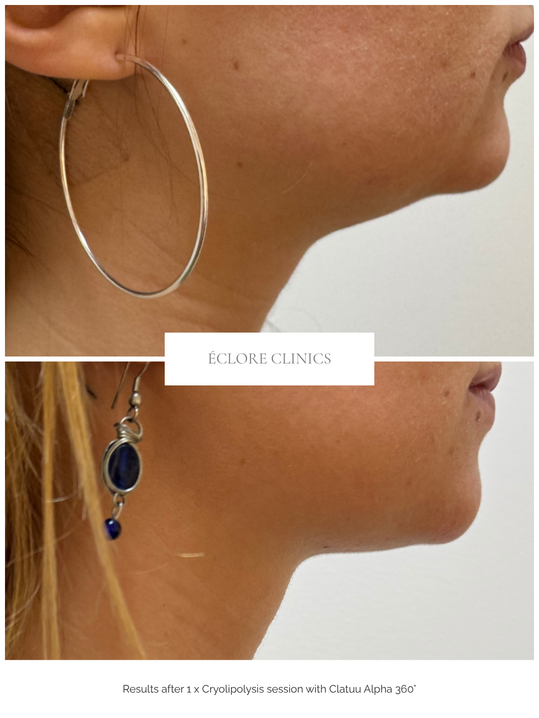 Before and after — Cryolipolysis at Éclore Clinics Utrecht